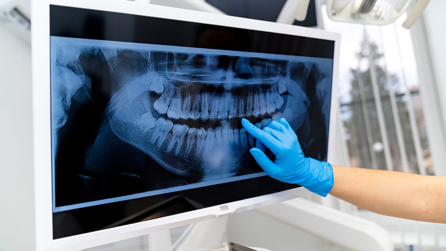 Radiografia dentară: când este necesară și cum se realizează?