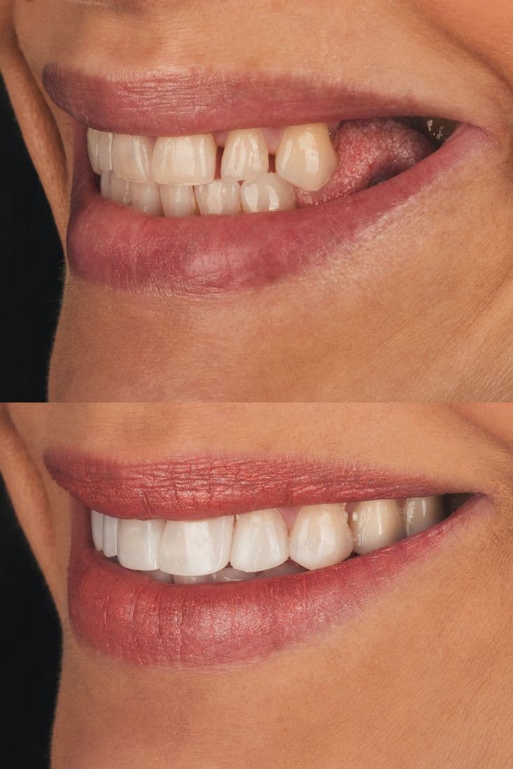 Implanuri dentare