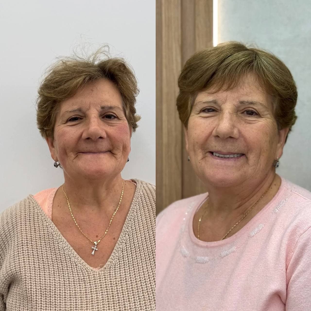 Proteză pe implanturi: rezultat final