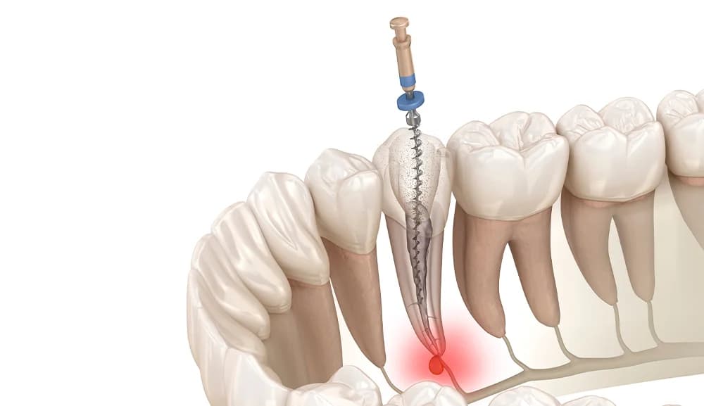 Endodonție — Prezentare generală
